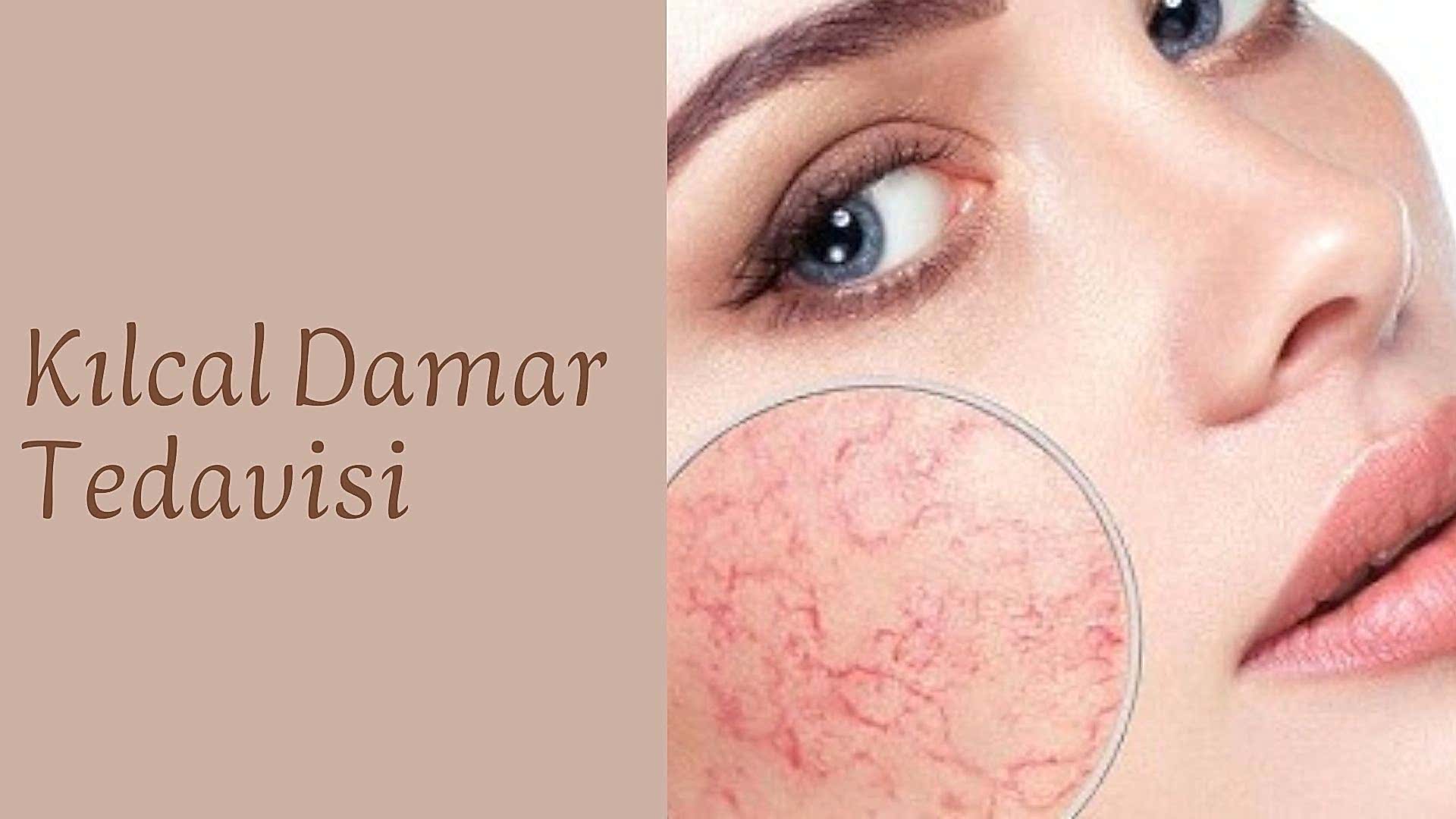 ankara kilcal damar tedavisi