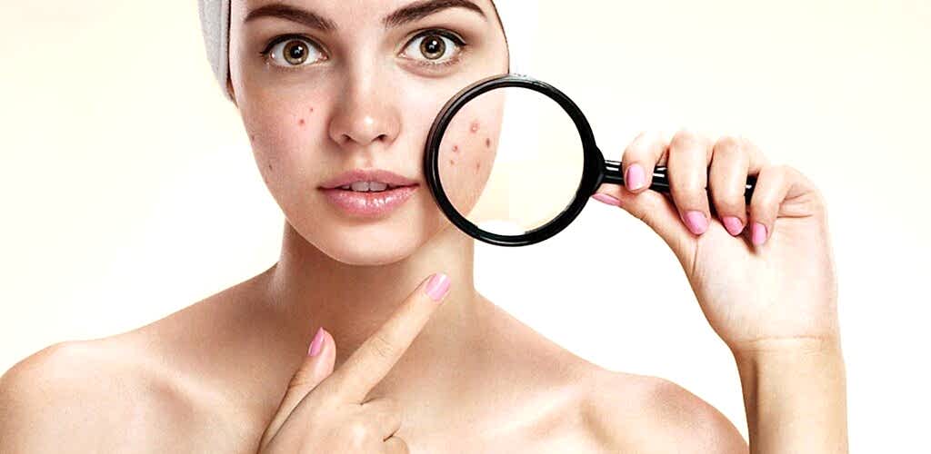 lazerden-sonra-sivilce-nasil-gecer