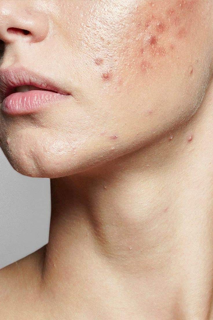 lazerden-sonra-sivilce