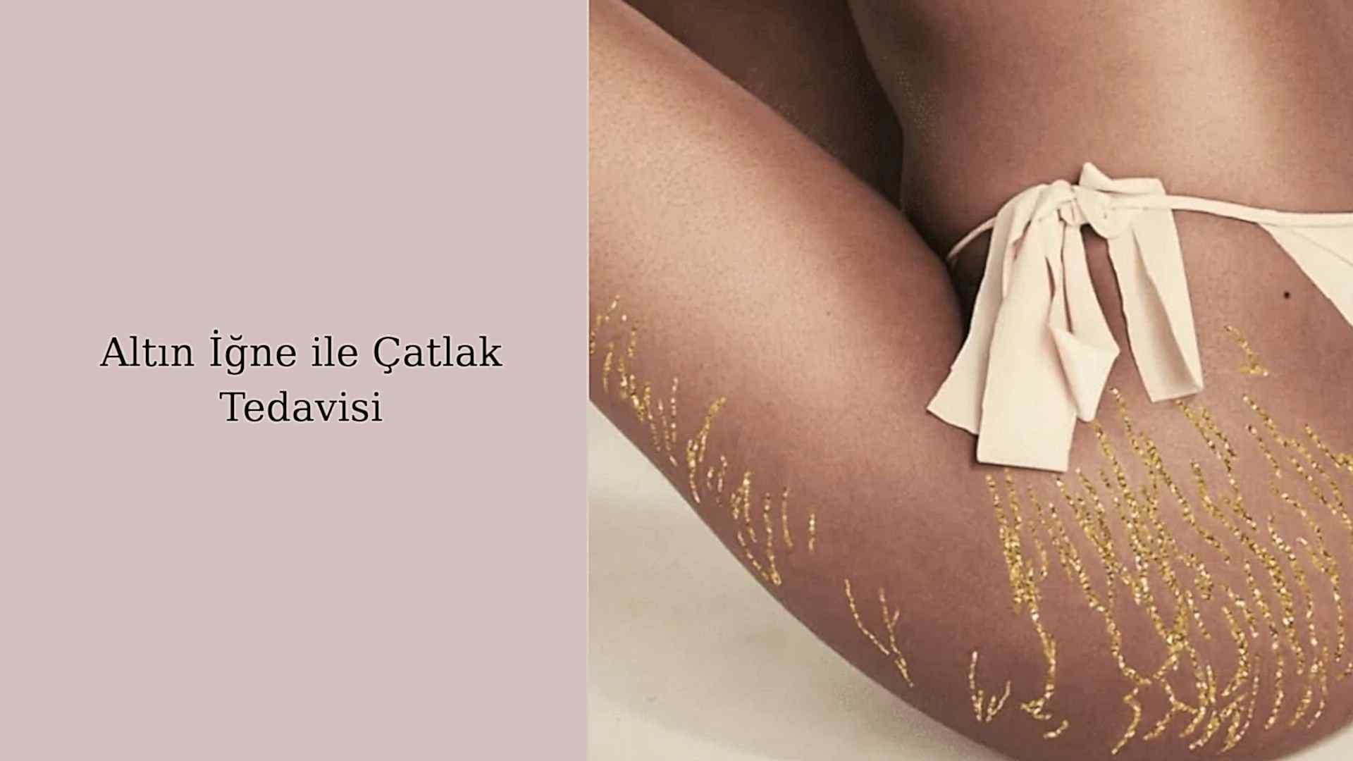 ankara altin igne catlak tedavisi