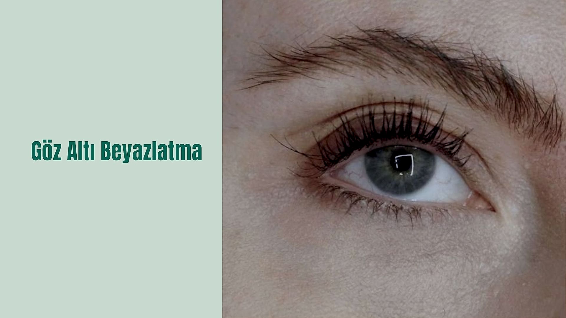 ankara goz alti beyazlatma