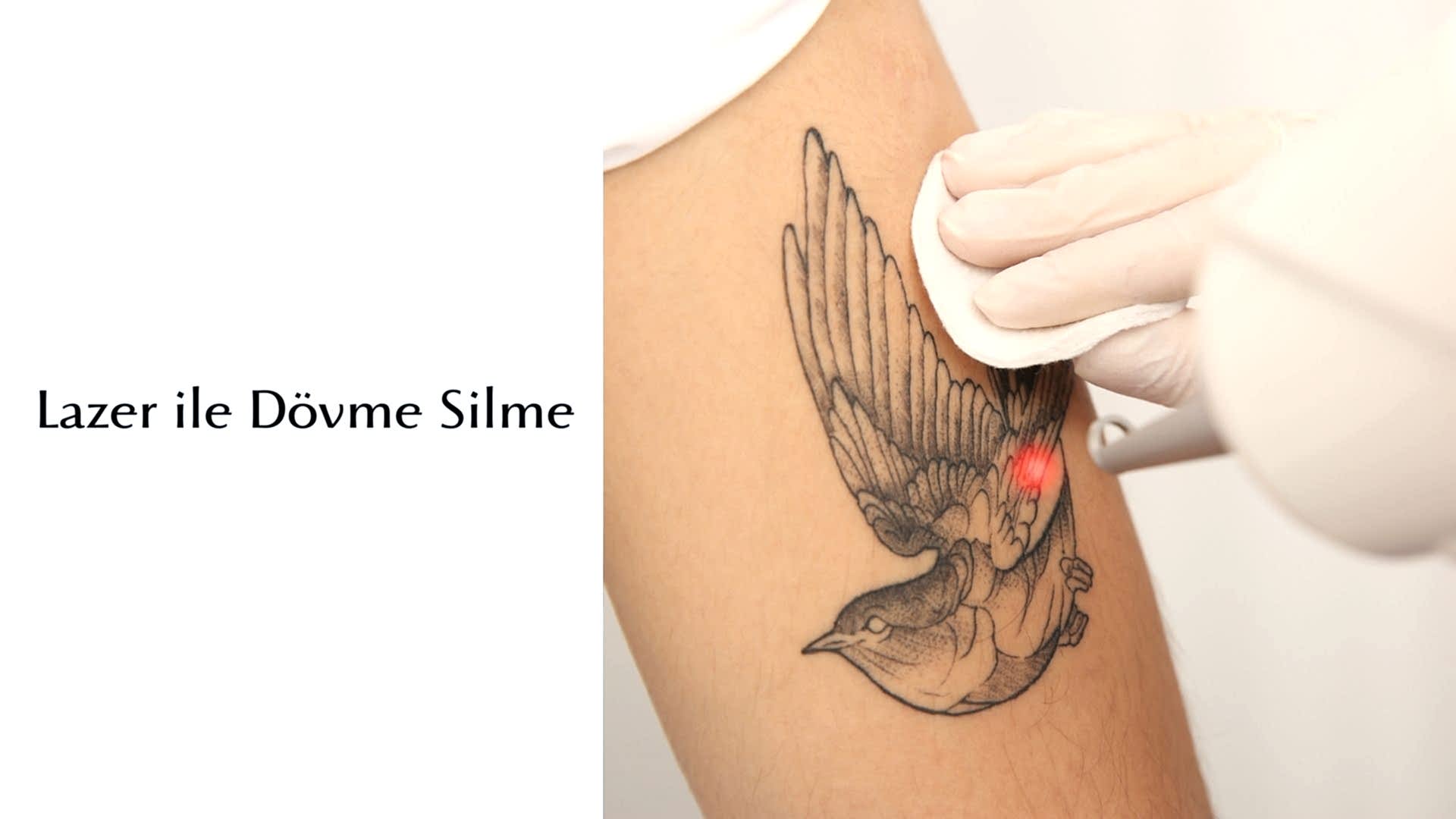 Lazer İle Dövme Silme