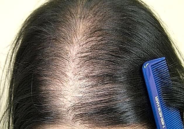 Kadın Tipi Saç Dökülmesi (Androjenik Alopesi) Nedir ve Nasıl Tedavi Edilir?