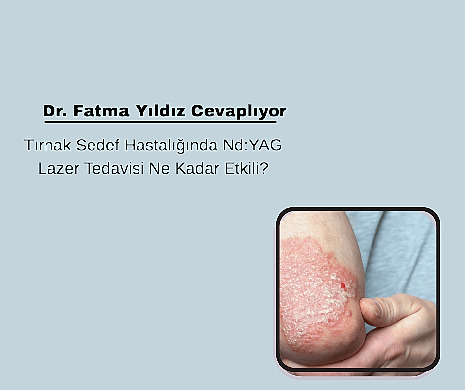 Tırnak Sedef Hastalığında Nd:YAG Lazer Tedavisi Ne Kadar Etkili?
