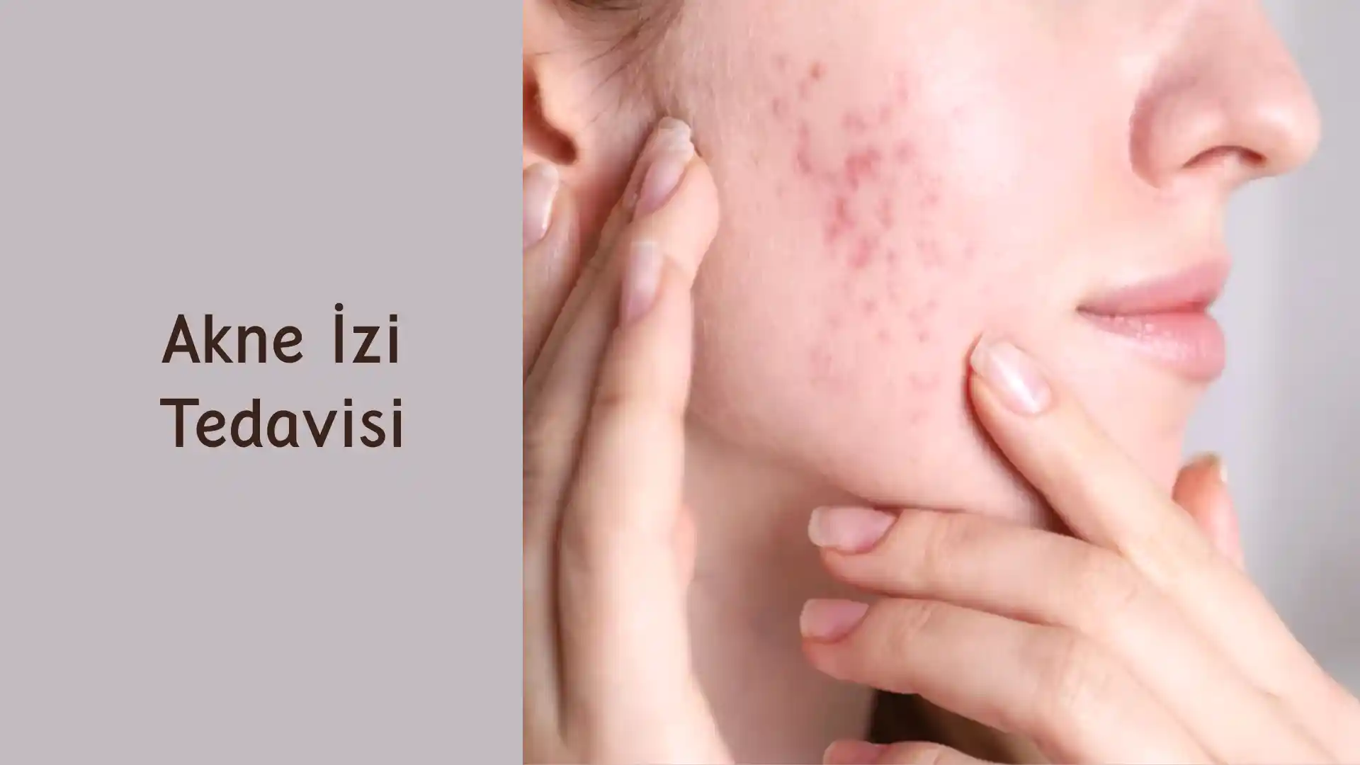 Akne İzi Tedavisi