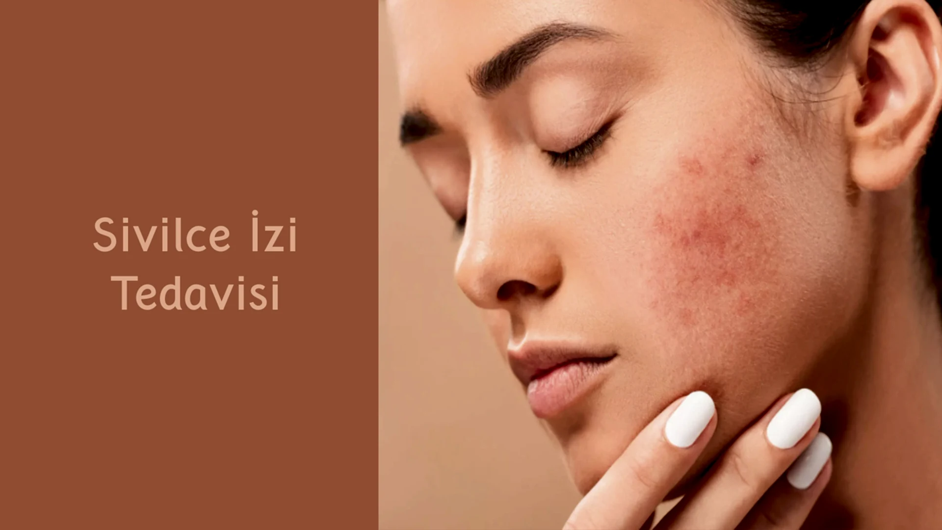 Sivilce İzi Tedavisi