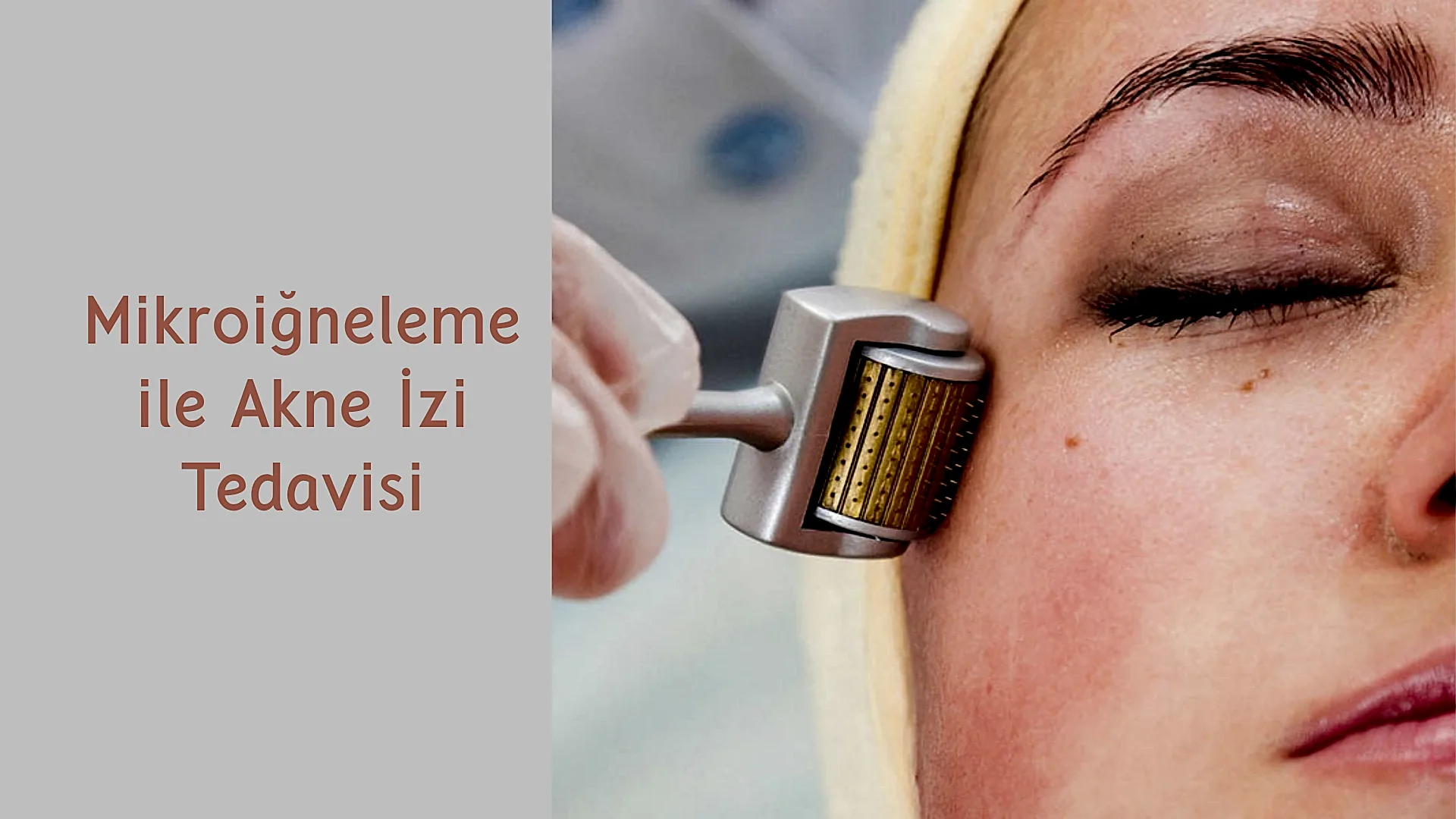 ankara mikroigneleme ile akne izi tedavisi