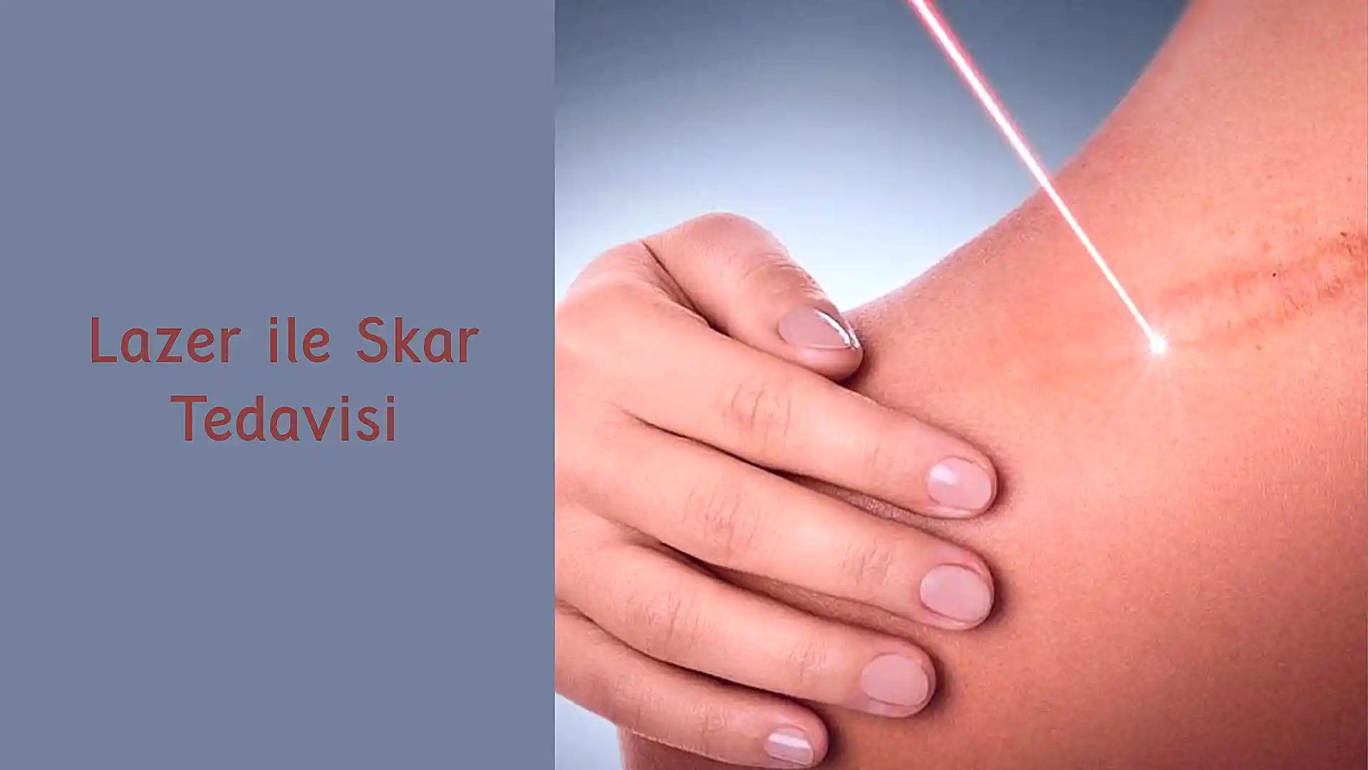 ankara lazer ile skar tedavisi