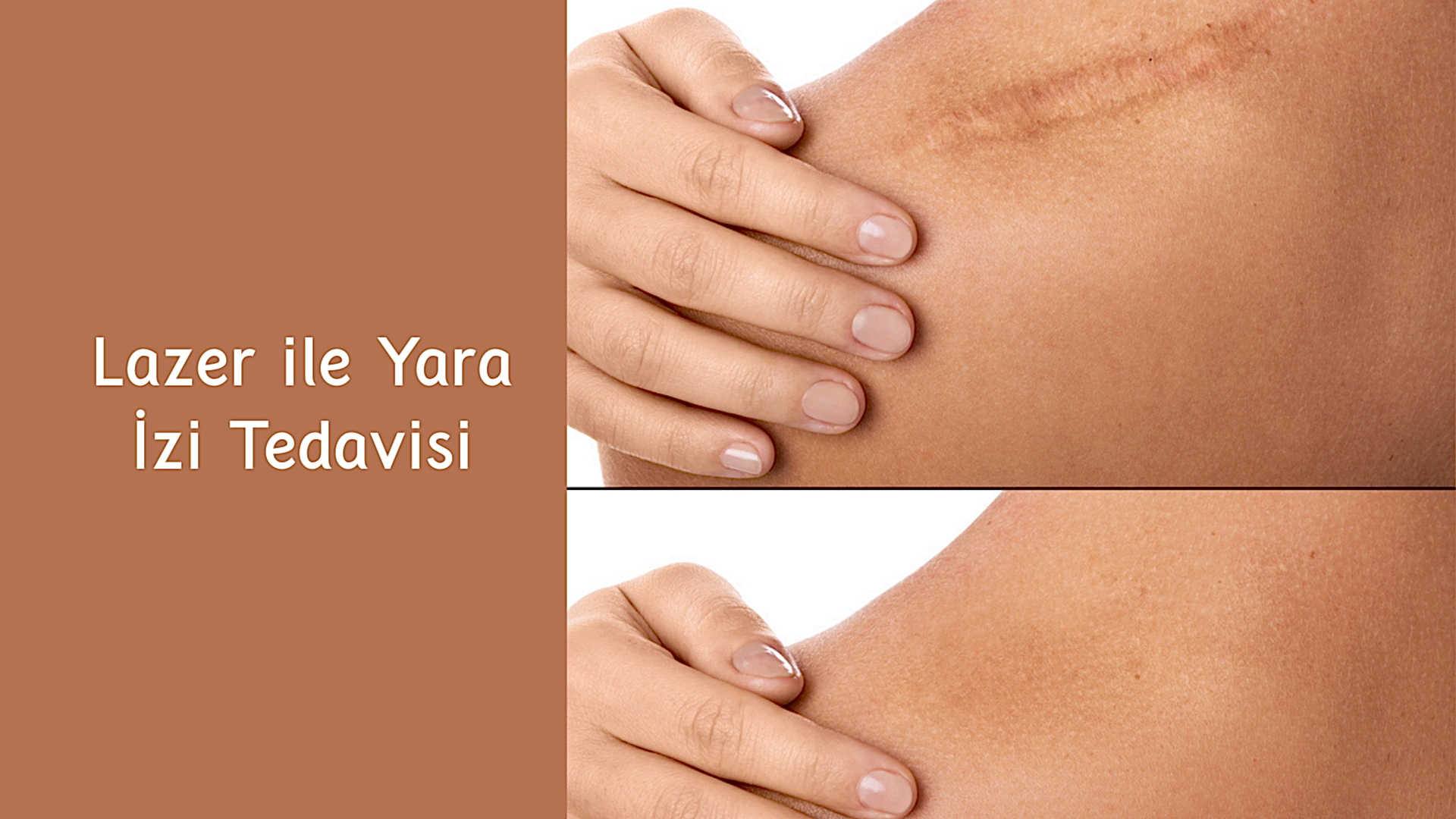 ankara lazer ile yara izi tedavisi