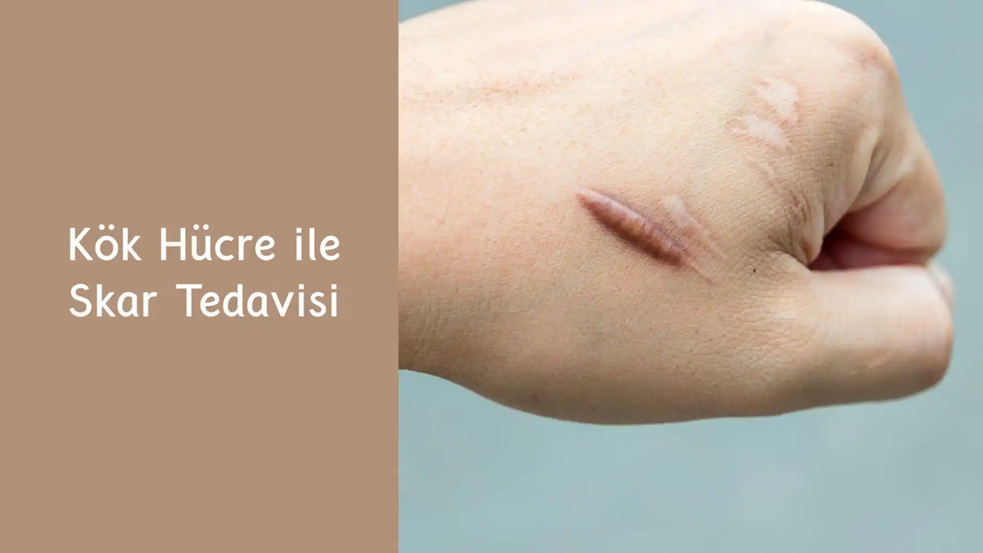 ankara kok hucre ile skar tedavisi