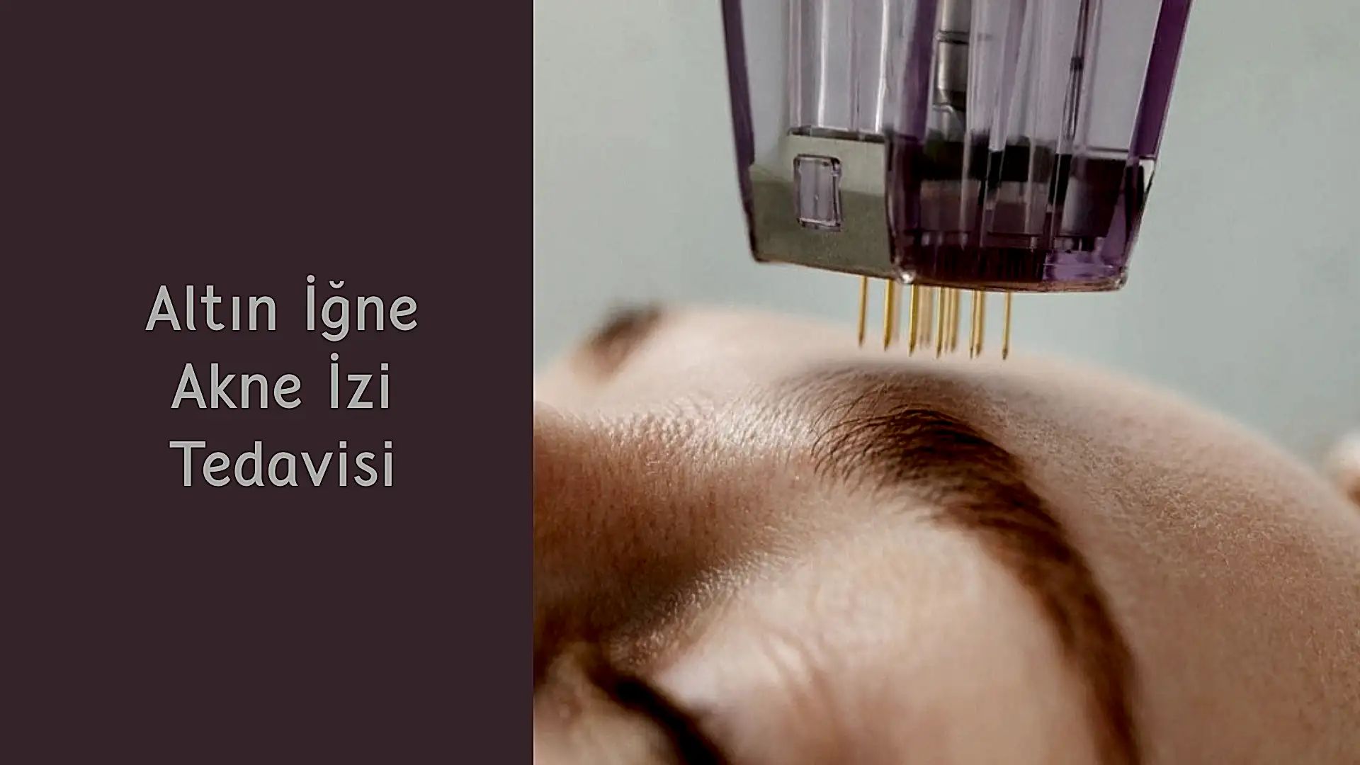 ankara altin igne akne izi tedavisi