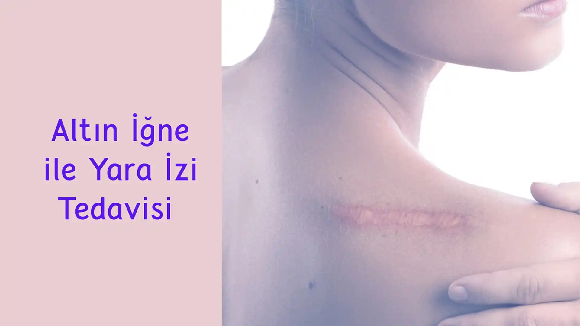 ankara altin igne ile yara izi tedavisi