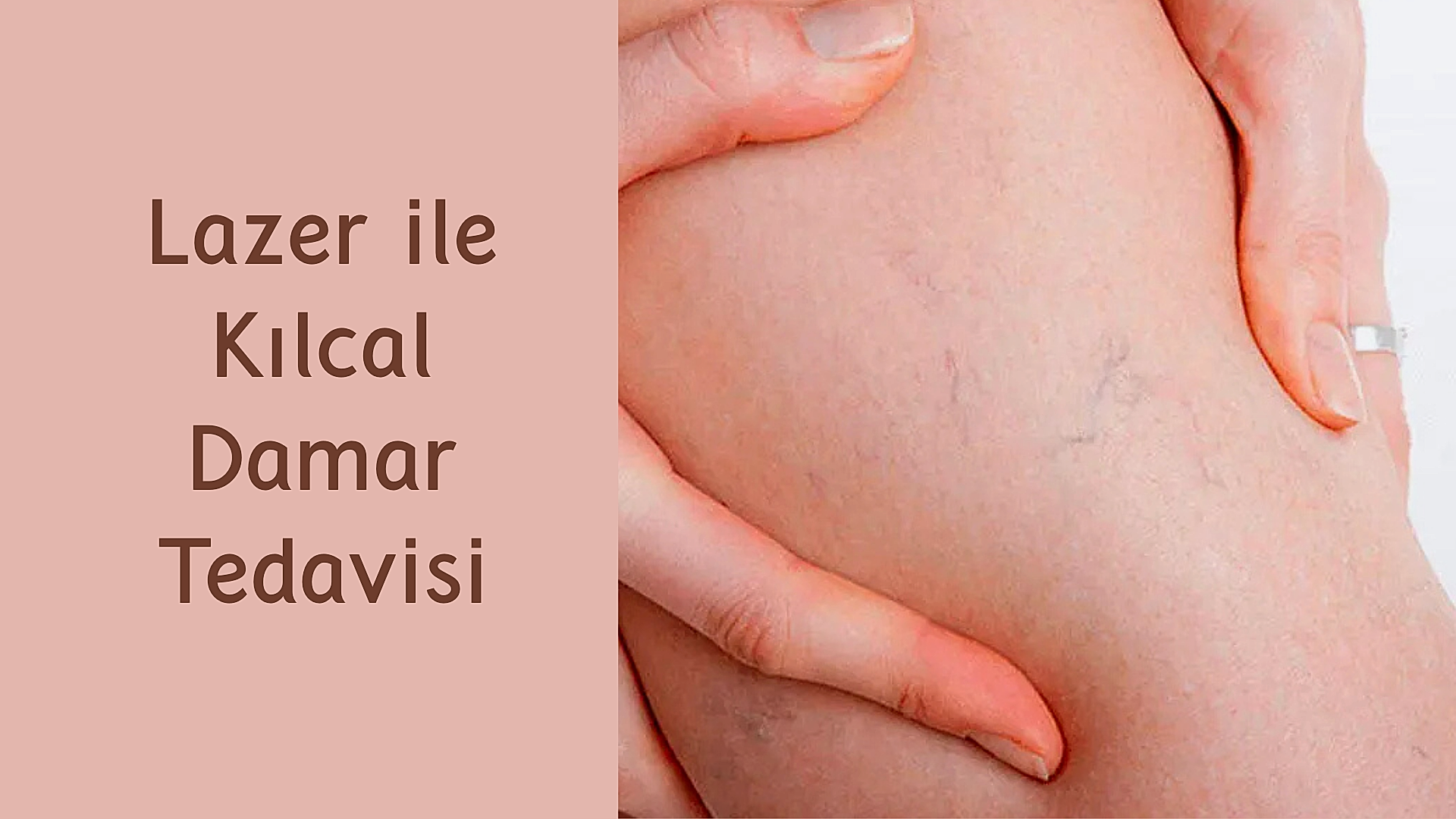ankara lazer ile kilcal damar tedavisi