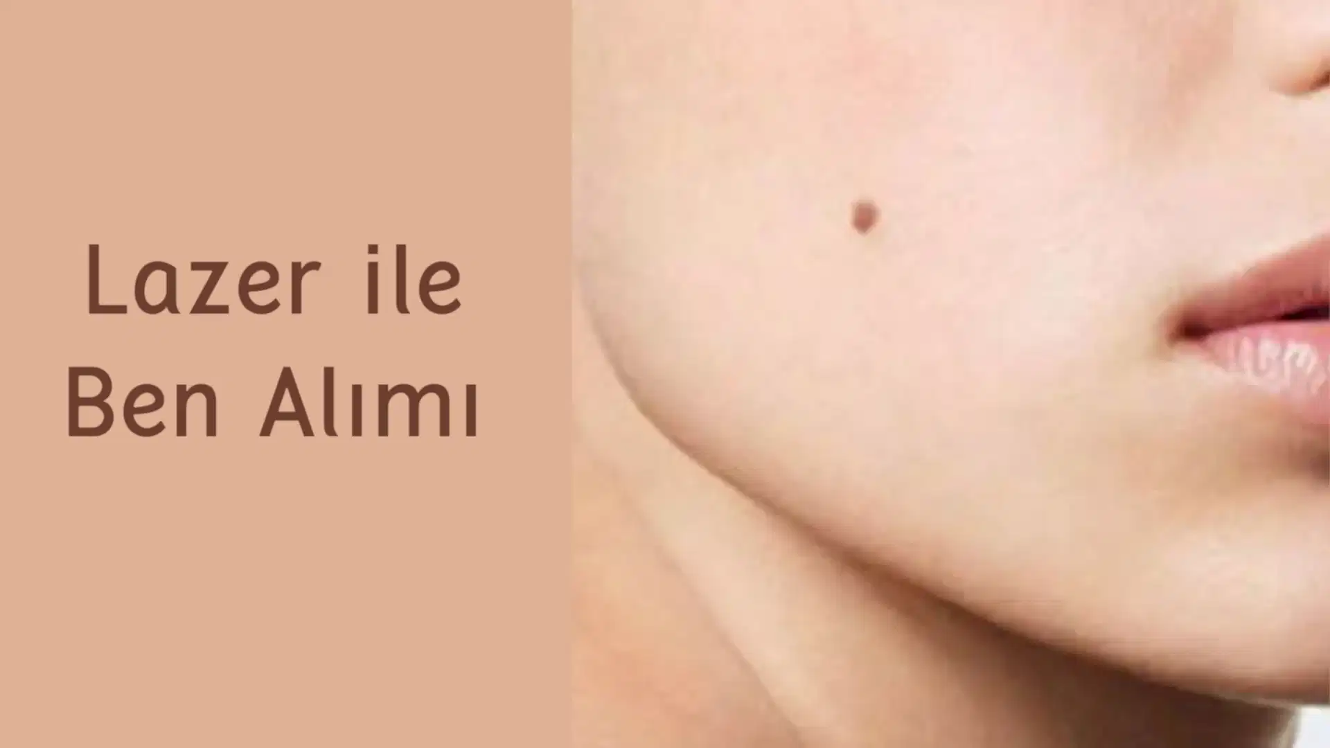 ankara lazer ile ben alimi