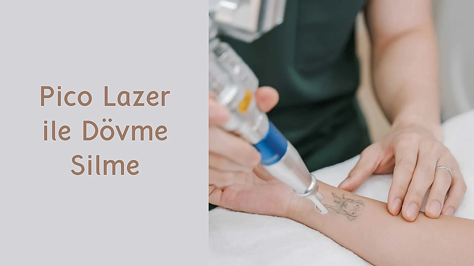 ankara pico lazer ile dovme silme