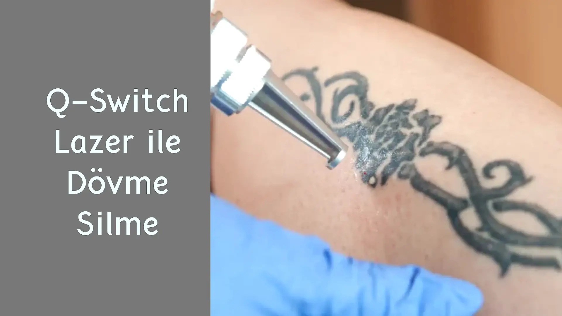 ankara q switch lazer ile dovme silme