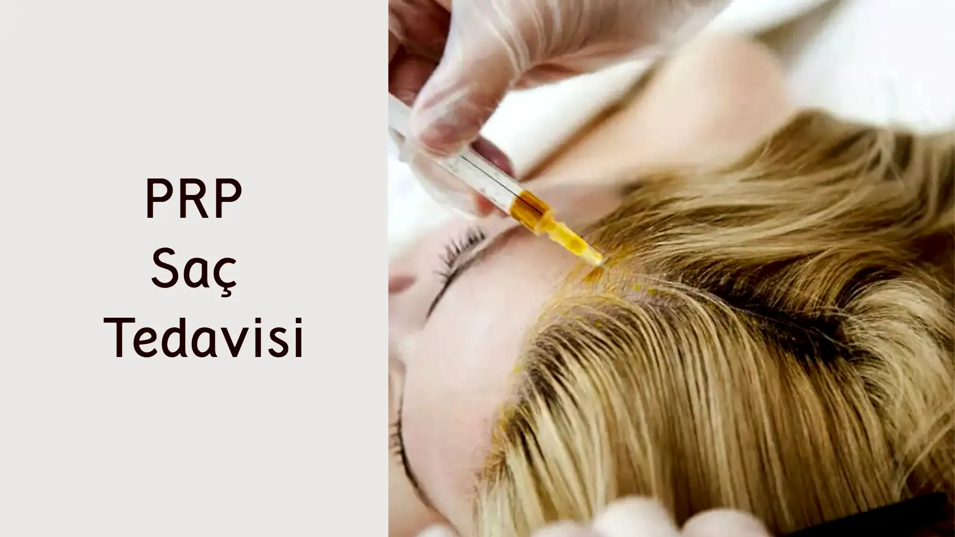 ankara prp sac tedavisi