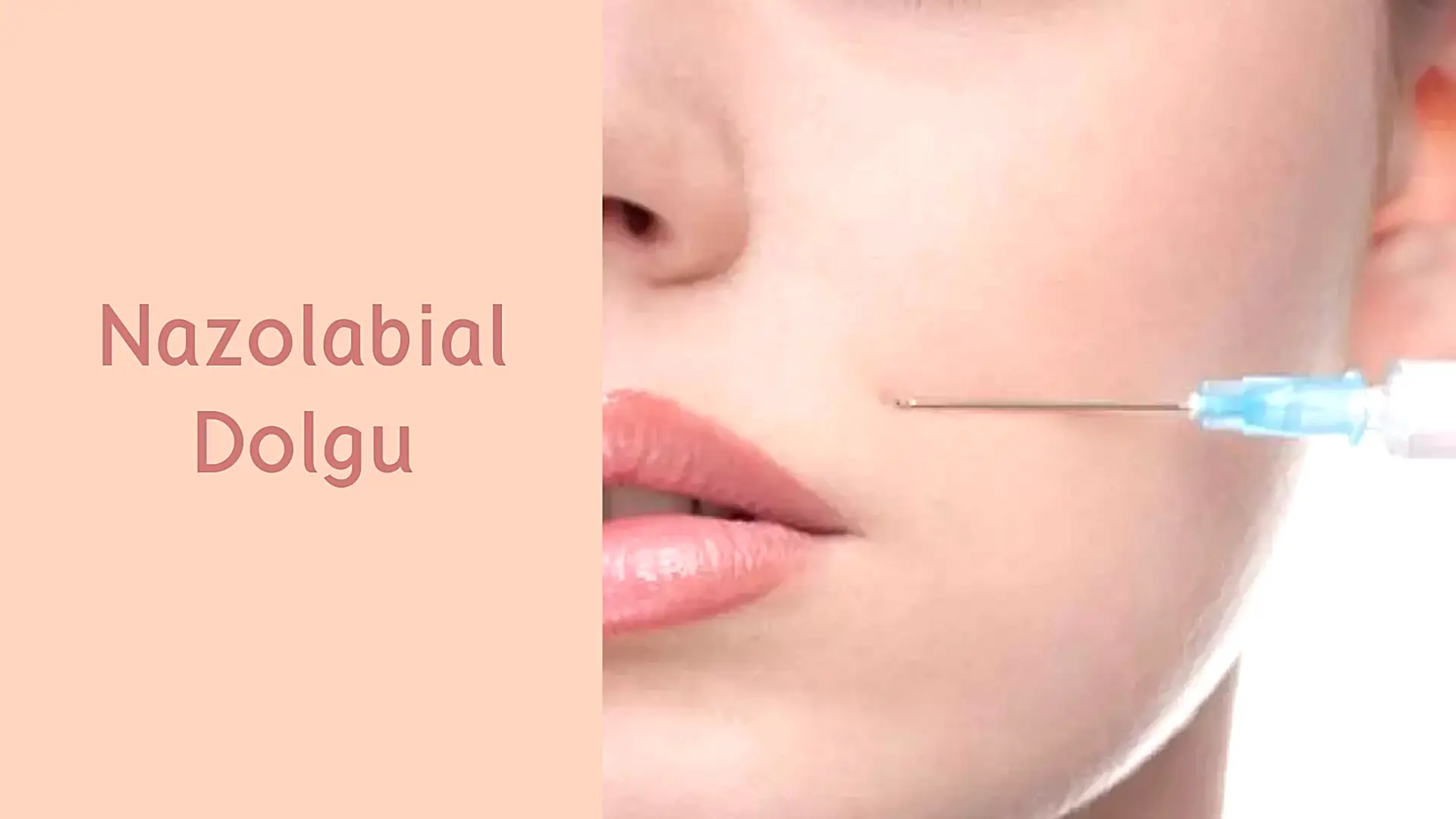 ankara nazolabial dolgu